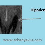 hipodens_nedir